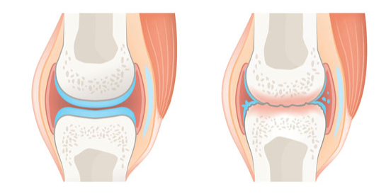 Gesundes und ungesundes Gelenk gegenübergestellt - mit und ohne Knorpel